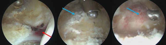 Resim-5: R kalça subspine sıkışma artroskopik görüntüleri. Kırmızı ok : Sıkışmaya bağlı subspinal alandaki sıkışmaya sekonder enflame doku Mavi ok:  Dekompresyon sonrası patolojik AİİS’nin görünümü ve eksizyon esnasında görünümü