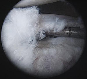 Resim 4: Femoro-asetabuler sıkışma hastalığında labrum yırtığının artroskopik görüntüsü