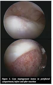 Resim 4: Femoroasetabuler sıkışma sendromunda sıkışmaya neden olan kemik bölge tıraşlanır.