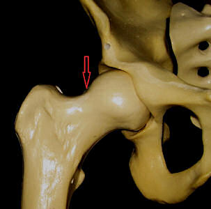Şekil 1b: İşaret asetabulum içinde femur başını göstermektedir