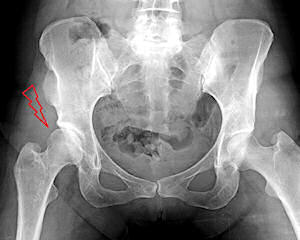 Şekil 2: Kalça displazisi olan bir hastanın röntgen filmi. İşaret karşı normal tarafa göre daha sığ olan ve femur başını yeterince örtmeyen asetabulumu göstermektedir