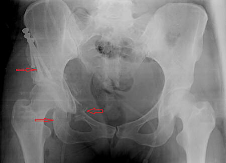 Şekil 5: Ganz osteotomisi yapılan aynı hastanın operasyon sonrası röntgeni. Asetabulumun femur başını örttüğü gözlenmektedir. İşaretler kemik kesilerini görtermektedir